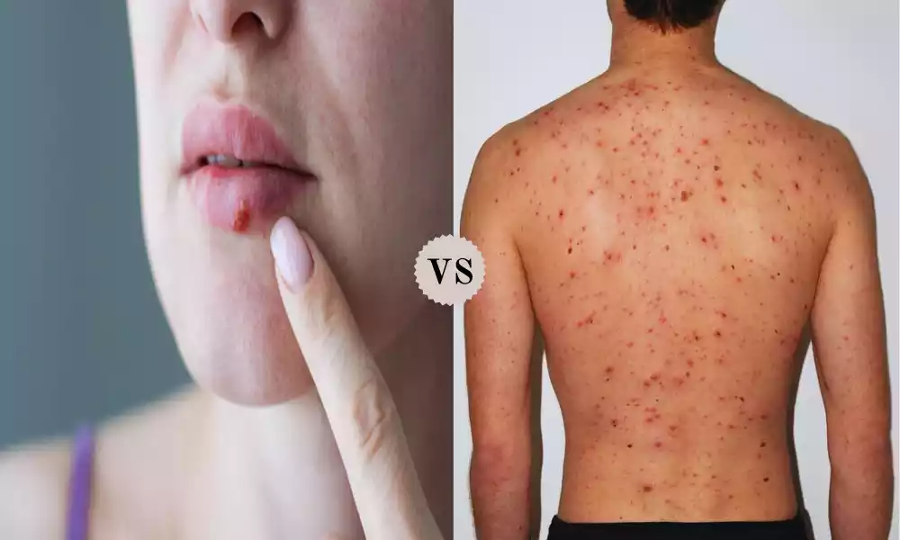 Herpes Simplex and Varicella Zoster
