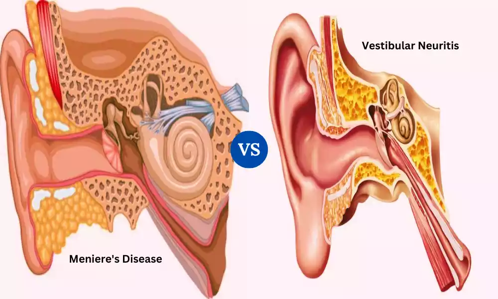 Meniere's Disease and Vestibular Neuritis
