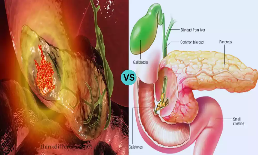 Pancreatic Cancer and Pancreatitis