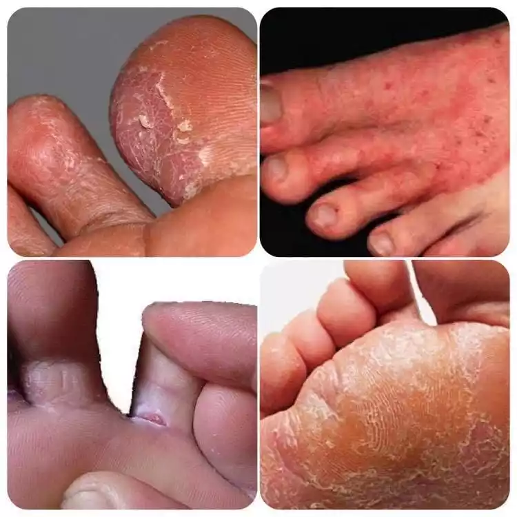 What is Athlete's Foot?