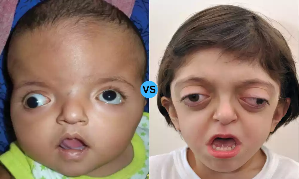 Apert and Crouzon Syndrome