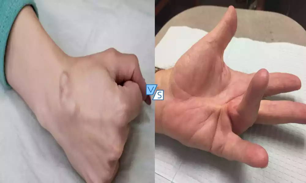 Ganglion Cyst and Dupuytren's Contracture