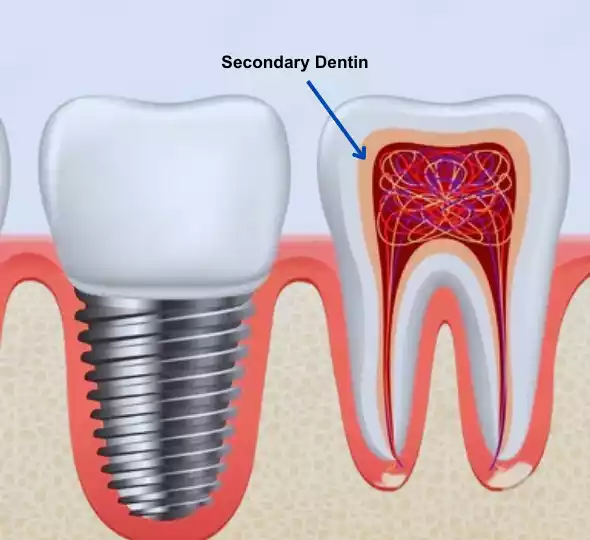 Secondary Dentin