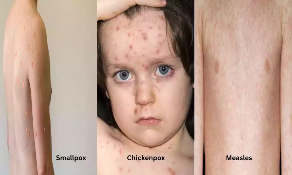 Smallpox and Chickenpox and Measles