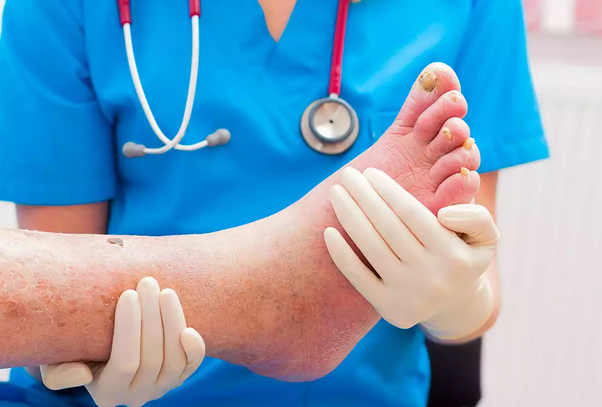 Diagnosis of Cellulitis and Lymphedema