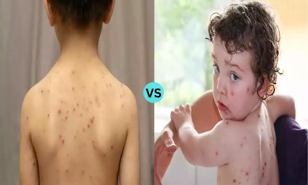 Monkeypox and Chickenpox