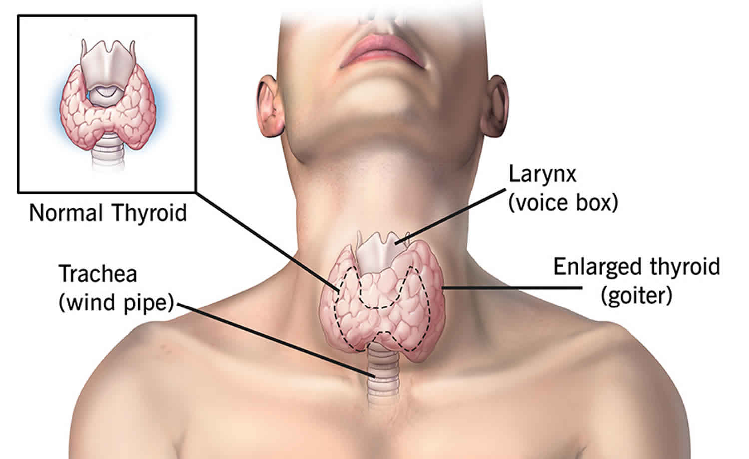 Difference Between Thyrotoxicosis and Hyperthyroidism Think Difference